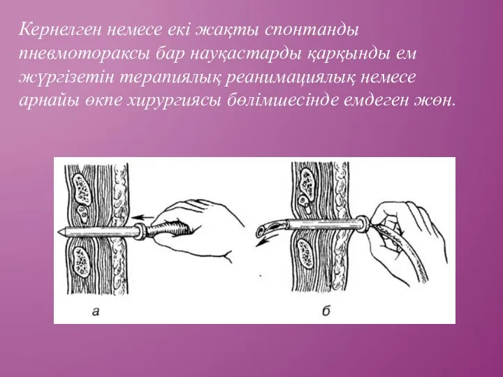 Кернелген немесе екі жақты спонтанды пневмотораксы бар науқастарды қарқынды ем