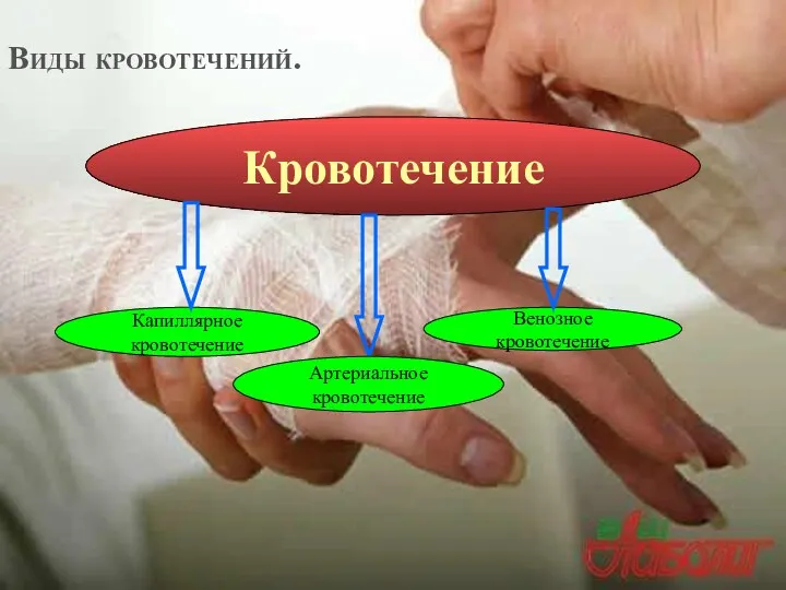 Виды кровотечений. Венозное кровотечение Кровотечение Капиллярное кровотечение Артериальное кровотечение