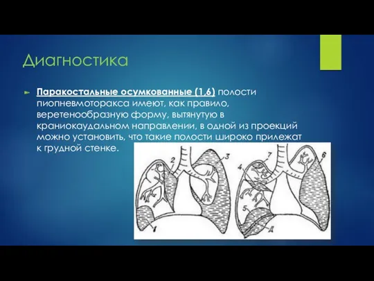 Диагностика Паракостальные осумкованные (1,6) полости пиопневмоторакса имеют, как правило, веретенообразную