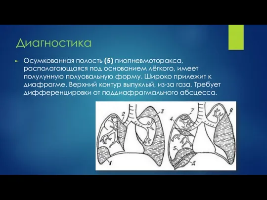 Диагностика Осумкованная полость (5) пиопневмоторакса, располагающаяся под основанием лёгкого, имеет