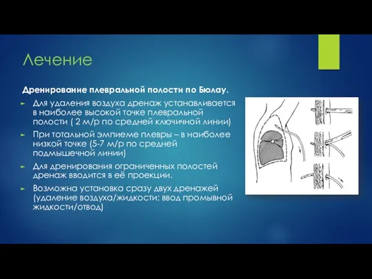 Лечение Дренирование плевральной полости по Бюлау. Для удаления воздуха дренаж