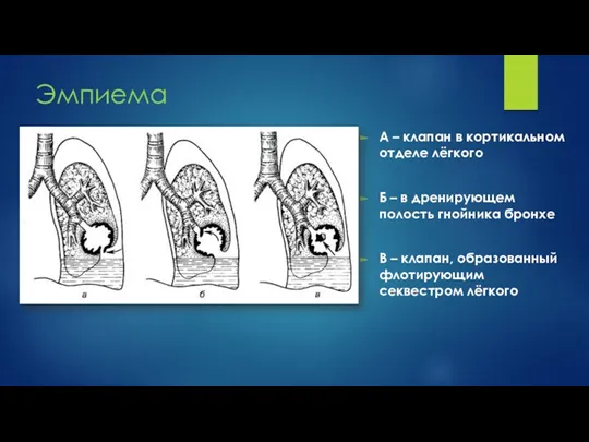 Эмпиема А – клапан в кортикальном отделе лёгкого Б –