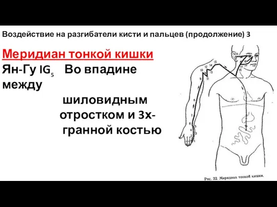 Воздействие на разгибатели кисти и пальцев (продолжение) 3 Меридиан тонкой кишки Ян-Гу IG5