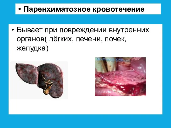 Бывает при повреждении внутренних органов( лёгких, печени, почек, желудка) Паренхиматозное кровотечение
