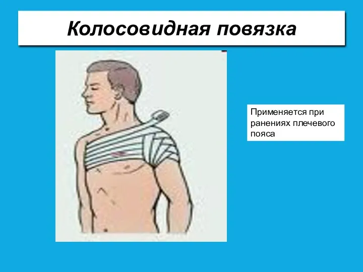 Колосовидная повязка Применяется при ранениях плечевого пояса