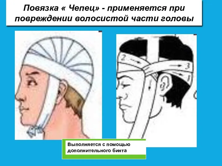 Повязка « Чепец» - применяется при повреждении волосистой части головы Выполняется с помощью дополнительного бинта