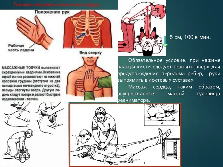 5 см, 100 в мин. Техника непрямого массажа сердца: Обязательное условие: при нажиме