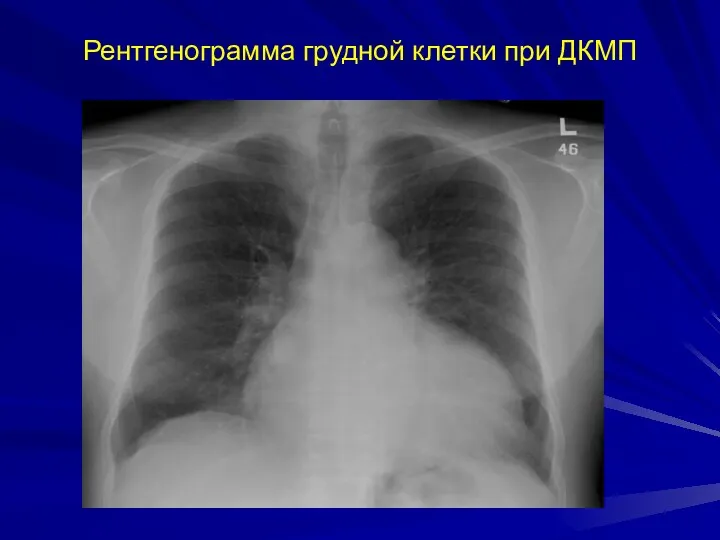 Рентгенограмма грудной клетки при ДКМП