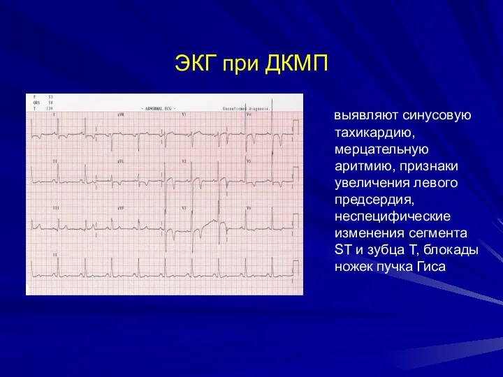 ЭКГ при ДКМП выявляют синусовую тахикардию, мерцательную аритмию, признаки увеличения