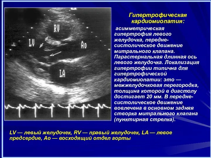 Гипертрофическая кардиомиопатия: асимметрическая гипертрофия левого желудочка, передне-систолическое движение митрального клапана.