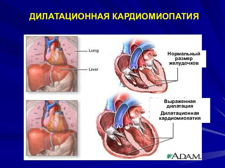 ДИЛАТАЦИОННАЯ КАРДИОМИОПАТИЯ Нормальный размер желудочков Выраженная дилатация Дилатационная кардиомиопатия