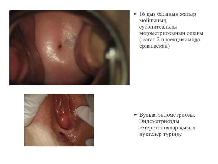 16 қыз баланың жатыр мойнының субэпитеальды эндометриозының ошағы ( сағат