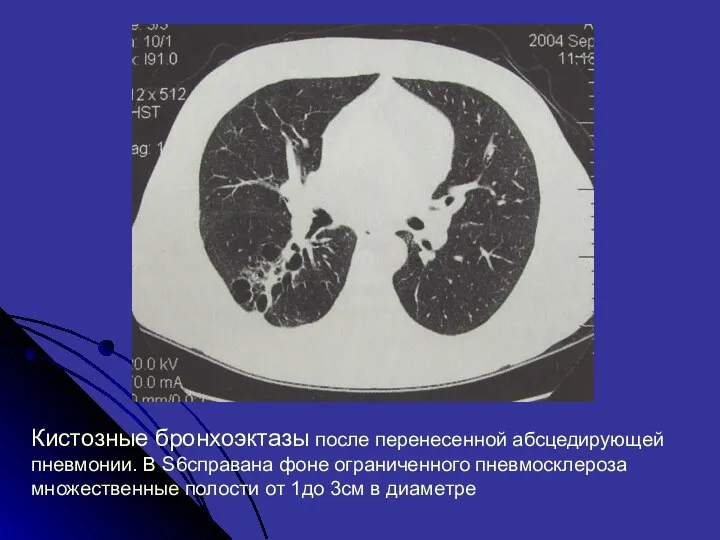 Кистозные бронхоэктазы после перенесенной абсцедирующей пневмонии. В S6справана фоне ограниченного