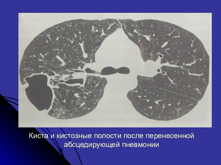 Киста и кистозные полости после перенесенной абсцедирующей пневмонии