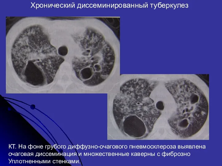 Хронический диссеминированный туберкулез КТ. На фоне грубого диффузно-очагового пневмосклероза выявлена