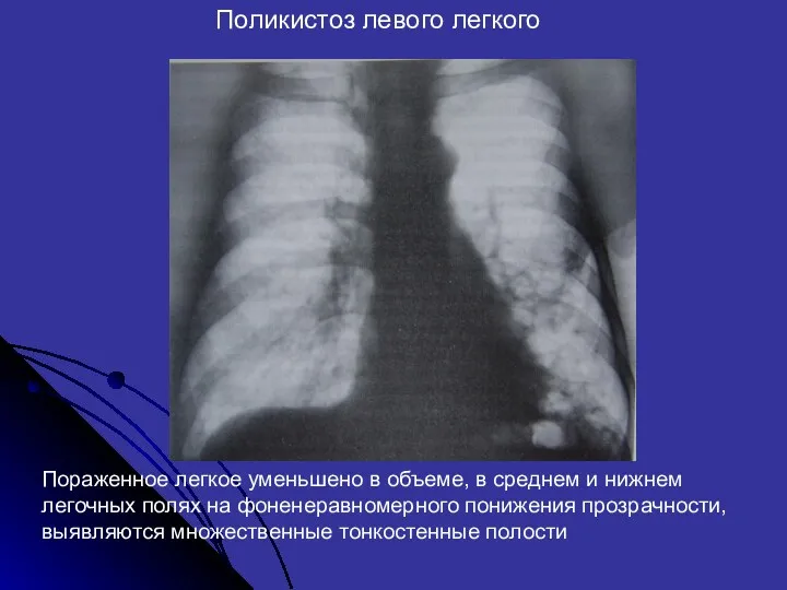 Поликистоз левого легкого Пораженное легкое уменьшено в объеме, в среднем