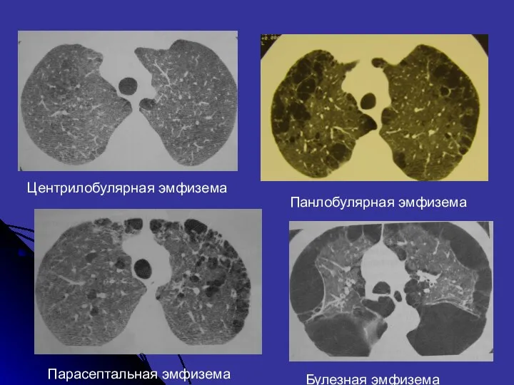 Панлобулярная эмфизема Парасептальная эмфизема Центрилобулярная эмфизема Булезная эмфизема