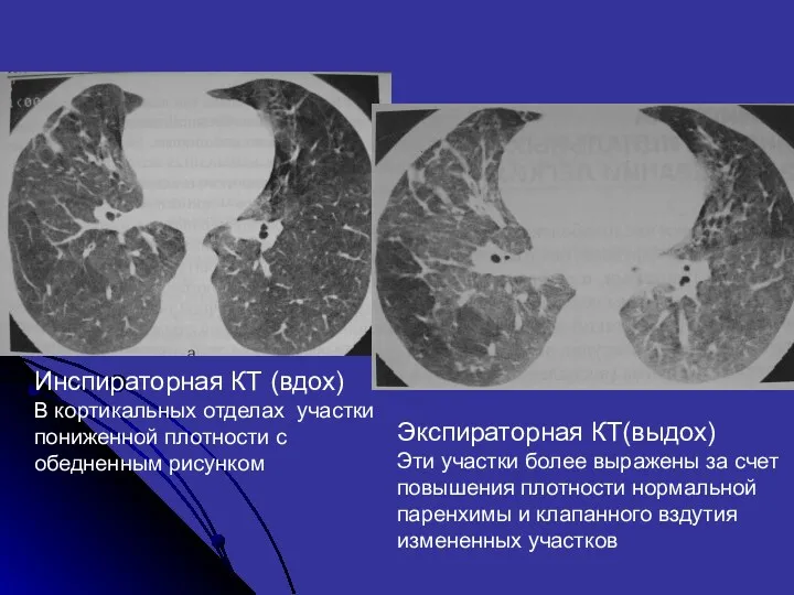 Инспираторная КТ (вдох) В кортикальных отделах участки пониженной плотности с