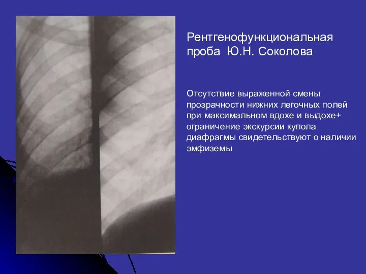 Рентгенофункциональная проба Ю.Н. Соколова Отсутствие выраженной смены прозрачности нижних легочных