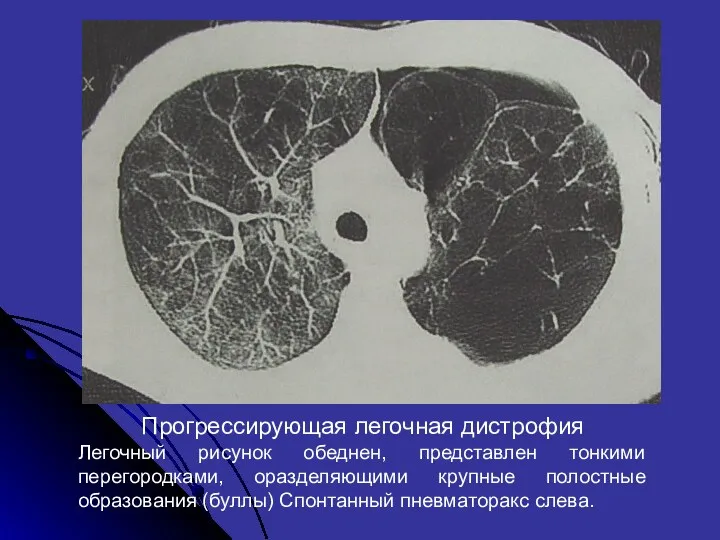 Прогрессирующая легочная дистрофия Легочный рисунок обеднен, представлен тонкими перегородками, оразделяющими