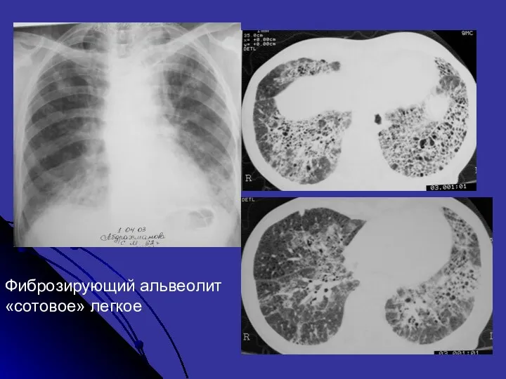 Фиброзирующий альвеолит «сотовое» легкое