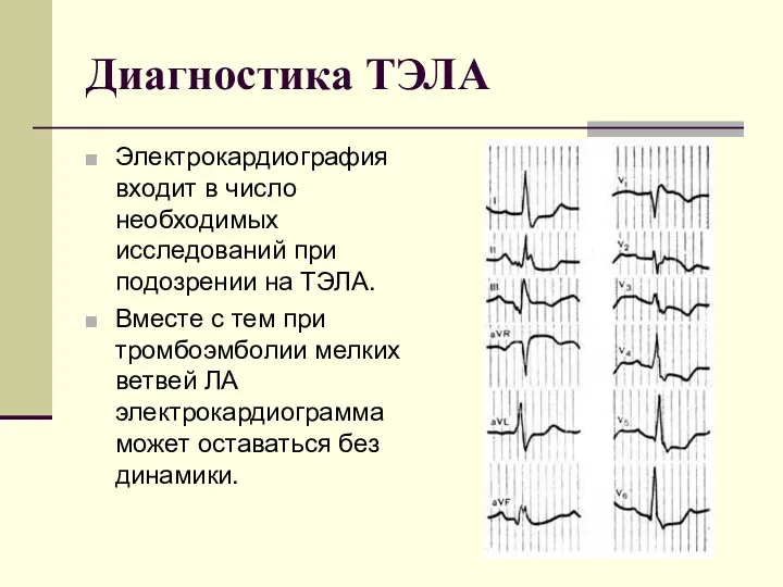 Диагностика ТЭЛА Электрокардиография входит в число необходимых исследований при подозрении на ТЭЛА. Вместе