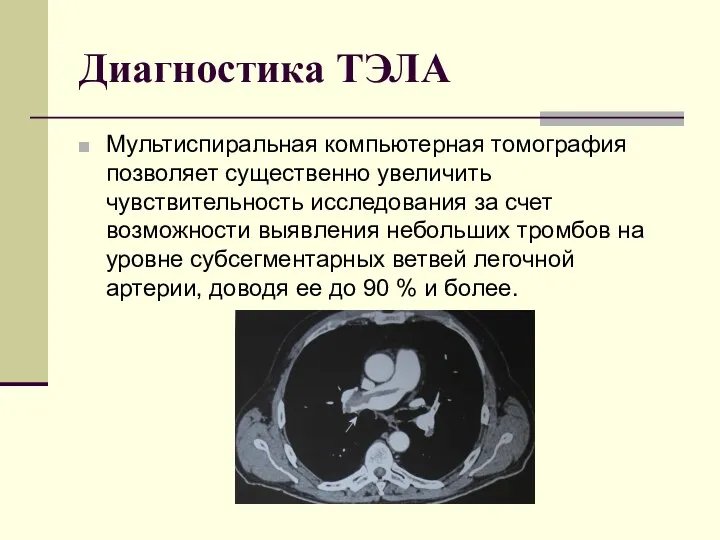 Диагностика ТЭЛА Мультиспиральная компьютерная томография позволяет существенно увеличить чувствительность исследования за счет возможности