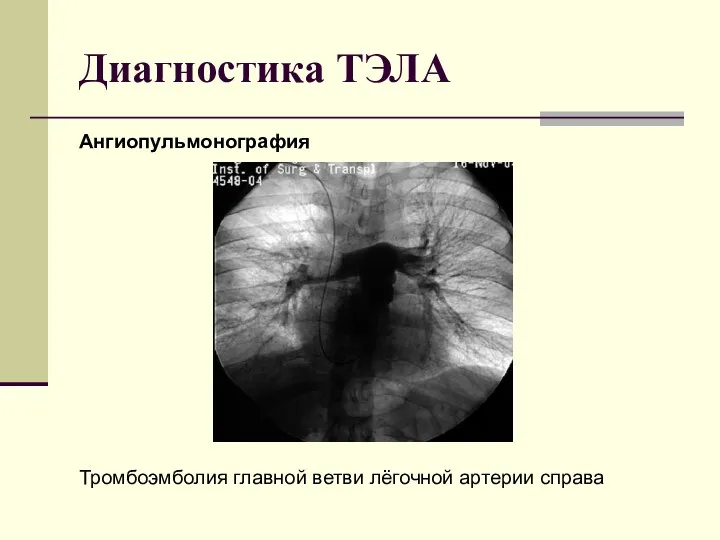 Диагностика ТЭЛА Ангиопульмонография Тромбоэмболия главной ветви лёгочной артерии справа
