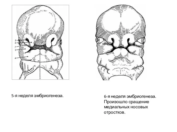 6-я неделя эмбриогенеза. Произошло сращение медиальных носовых отростков. 5-я неделя эмбриогенеза.