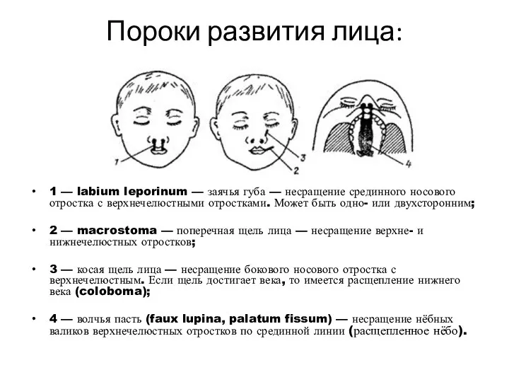 Пороки развития лица: 1 — labium leporinum — заячья губа