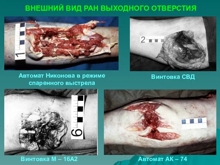 ВНЕШНИЙ ВИД РАН ВЫХОДНОГО ОТВЕРСТИЯ