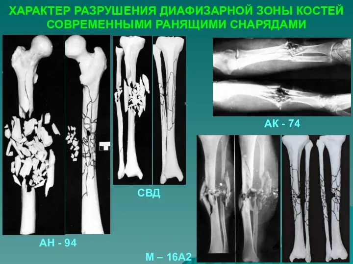 ХАРАКТЕР РАЗРУШЕНИЯ ДИАФИЗАРНОЙ ЗОНЫ КОСТЕЙ СОВРЕМЕННЫМИ РАНЯЩИМИ СНАРЯДАМИ СВД АН