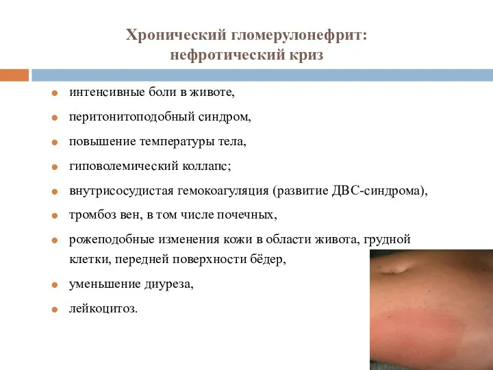 Хронический гломерулонефрит: нефротический криз интенсивные боли в животе, перитонитоподобный синдром,