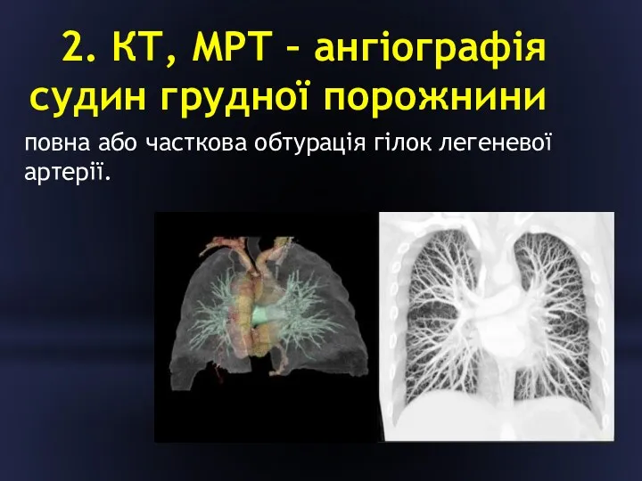 2. КТ, МРТ – ангіографія судин грудної порожнини повна або часткова обтурація гілок легеневої артерії.