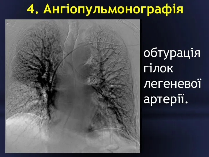 4. Ангіопульмонографія обтурація гілок легеневої артерії.