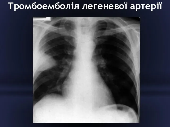 Тромбоемболія легеневої артерії