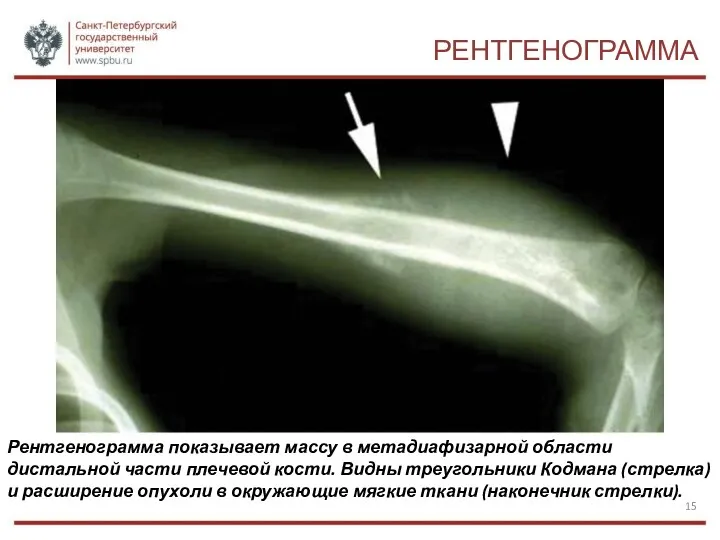 РЕНТГЕНОГРАММА Рентгенограмма показывает массу в метадиафизарной области дистальной части плечевой кости. Видны треугольники