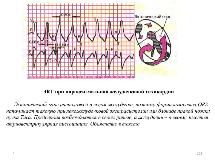 ЭКГ при пароксизмальной желудочковой тахикардии Эктопический очаг расположен в левом