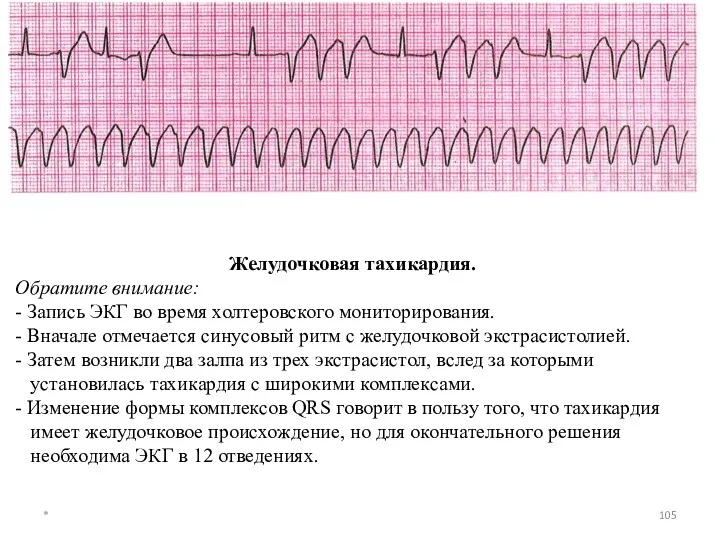 Желудочковая тахикардия. Обратите внимание: - Запись ЭКГ во время холтеровского