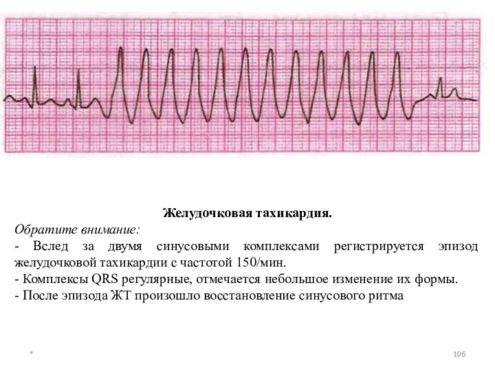 Желудочковая тахикардия. Обратите внимание: - Вслед за двумя синусовыми комплексами