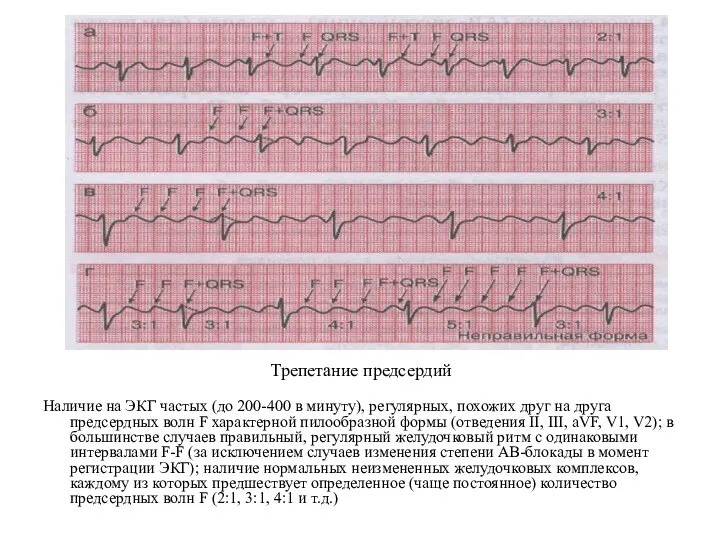 Трепетание предсердий Наличие на ЭКГ частых (до 200-400 в минуту),