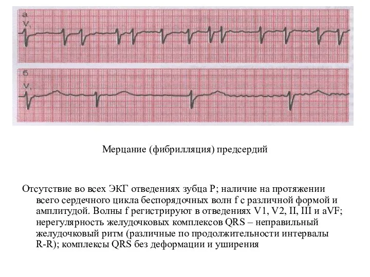 Мерцание (фибрилляция) предсердий Отсутствие во всех ЭКГ отведениях зубца Р;