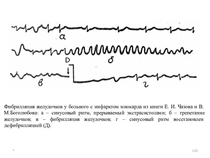 Фибрилляция желудочков у больного с инфарктом миокарда из книги Е.