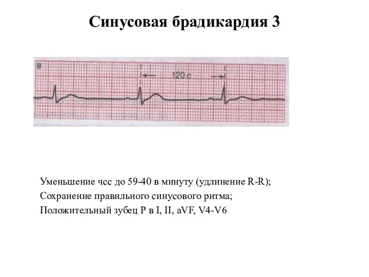 Синусовая брадикардия 3 Уменьшение чсс до 59-40 в минуту (удлинение