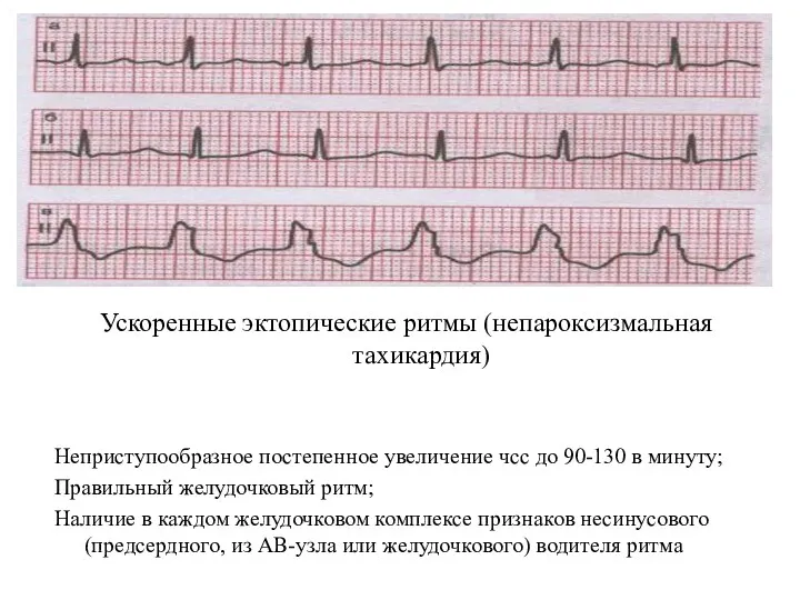 Ускоренные эктопические ритмы (непароксизмальная тахикардия) Неприступообразное постепенное увеличение чсс до