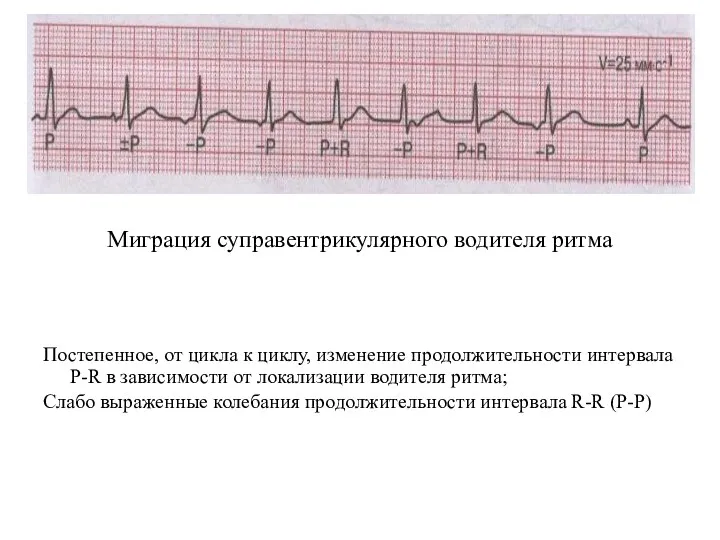 Миграция суправентрикулярного водителя ритма Постепенное, от цикла к циклу, изменение