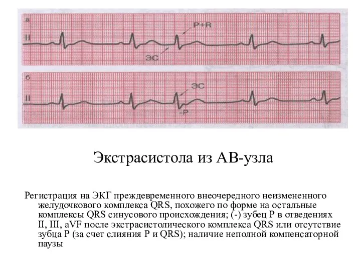 Экстрасистола из АВ-узла Регистрация на ЭКГ преждевременного внеочередного неизмененного желудочкового