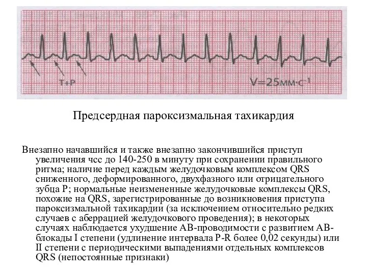 Предсердная пароксизмальная тахикардия Внезапно начавшийся и также внезапно закончившийся приступ