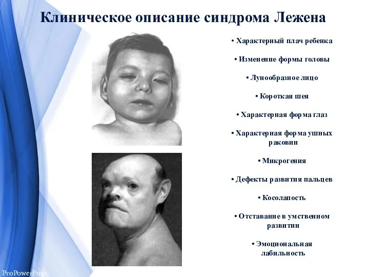 Клиническое описание синдрома Лежена Характерный плач ребенка Изменение формы головы