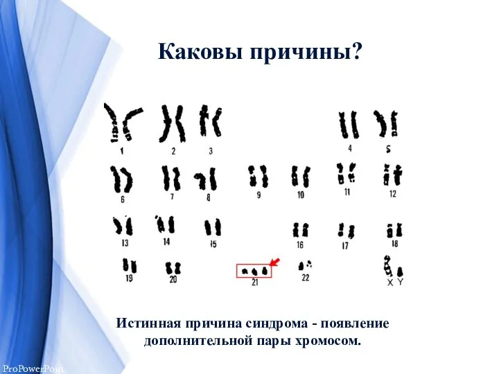 Каковы причины? Истинная причина синдрома - появление дополнительной пары хромосом.